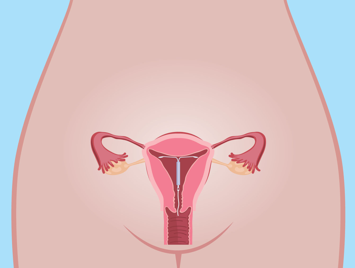IUD